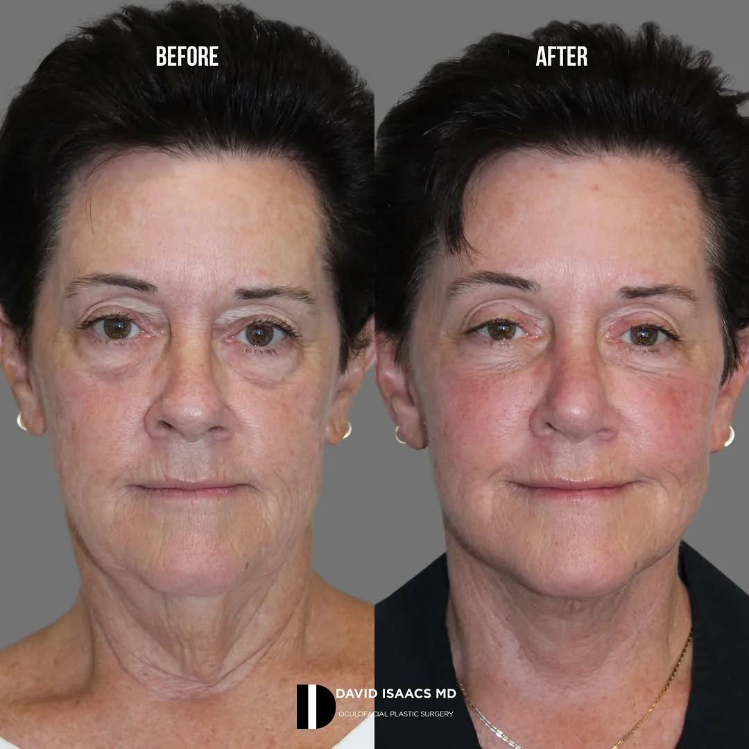 Before and after deep plane facelift — 58-year-old woman, frontal view, 6mo post-op by Dr. David Isaacs