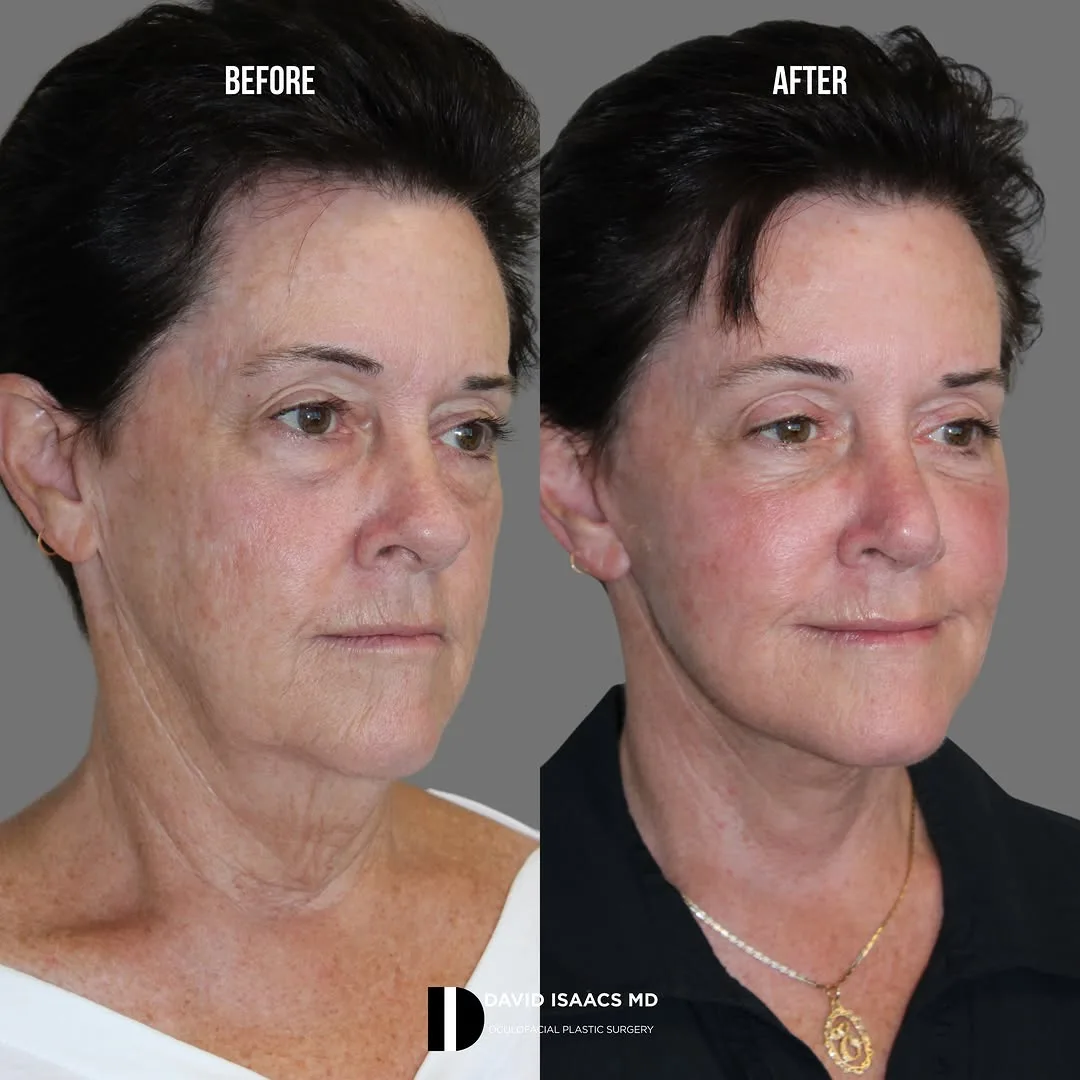 Before and after deep plane facelift — 58-year-old woman, oblique left view, 6mo post-op by Dr. David Isaacs