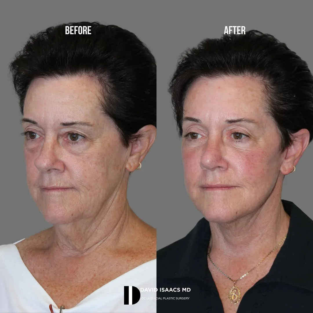 Before and after deep plane facelift — 58-year-old woman, oblique left view, 6mo post-op by Dr. David Isaacs