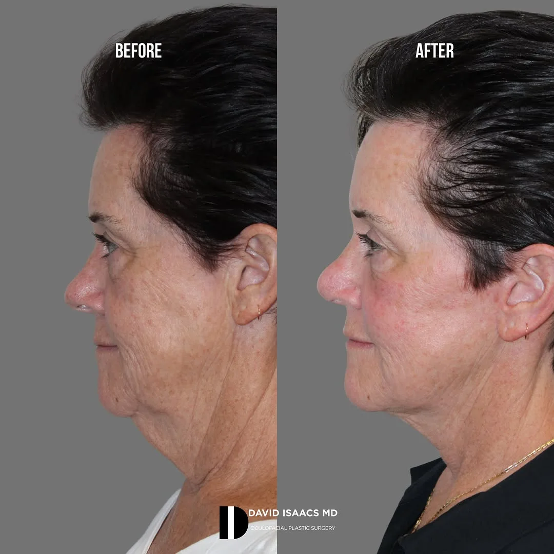 Before and after deep plane facelift — 58-year-old woman, right profile view, 6mo post-op by Dr. David Isaacs