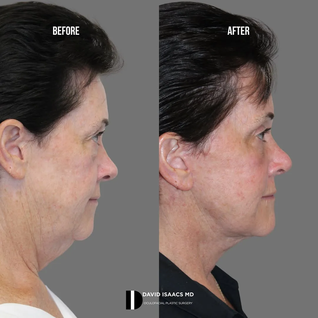 Before and after deep plane facelift — 58-year-old woman, right profile view, 6mo post-op by Dr. David Isaacs
