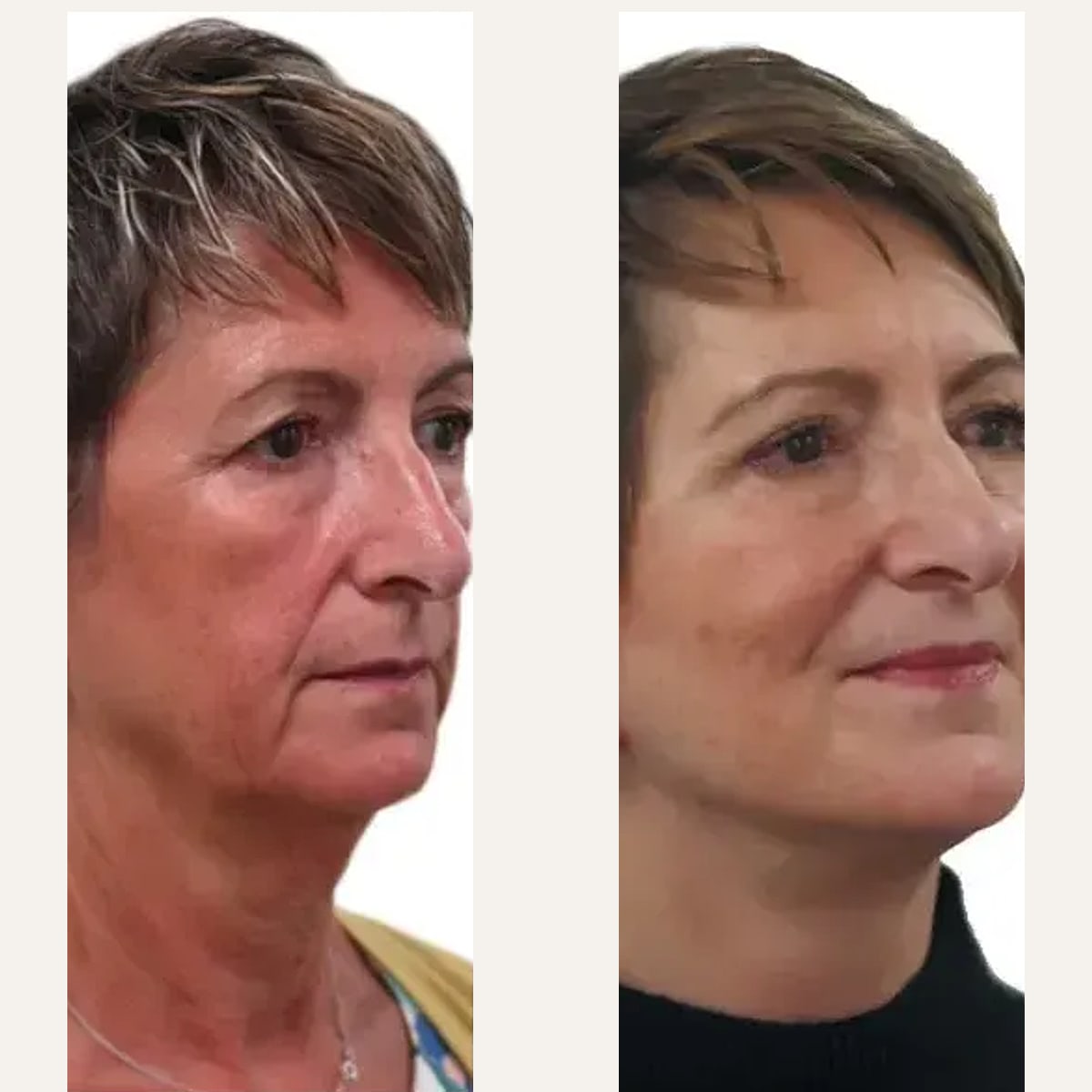 До и после — Deep Plane Facelift от доктора David J. Just