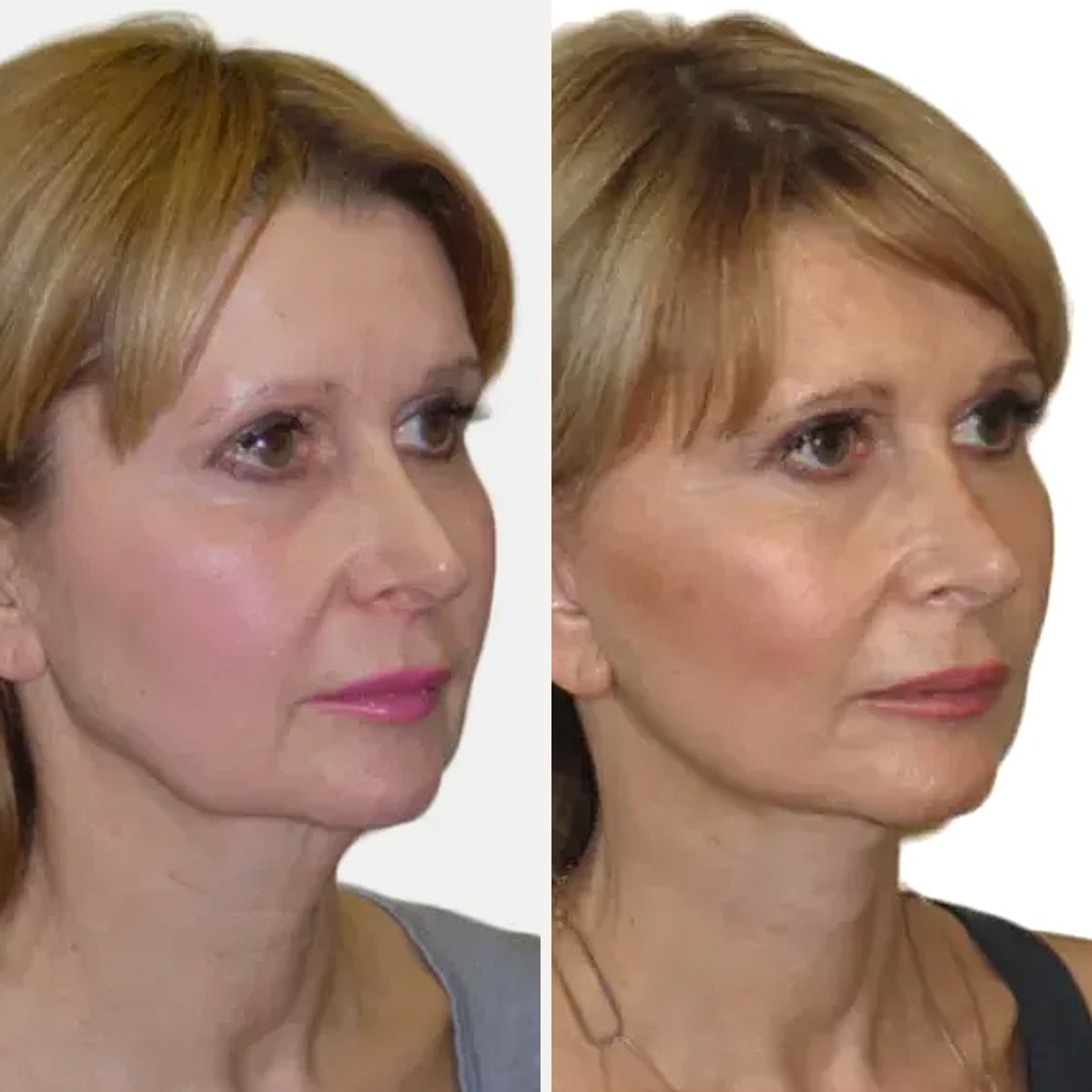 До и после — Deep Plane Facelift от доктора David J. Just