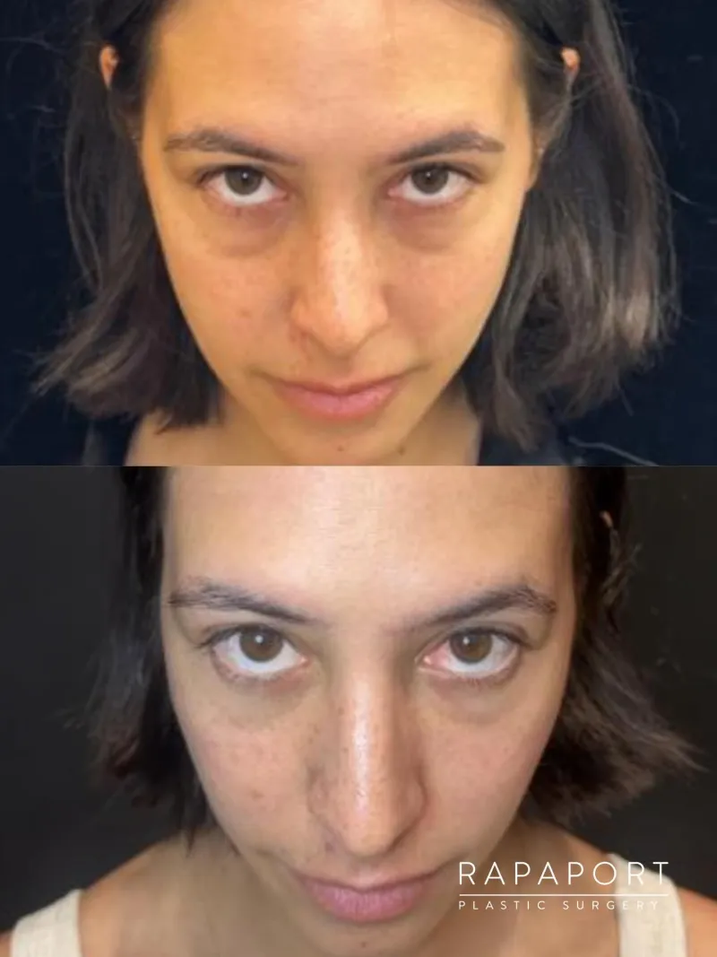 Before and after — Dr. David Rapaport