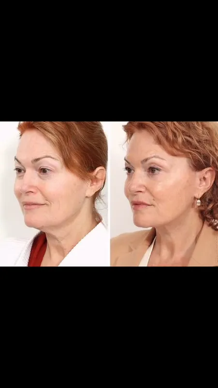 Before and after deep plane facelift — -1-year-old patient, frontal view by Dr. David Rosenberg
