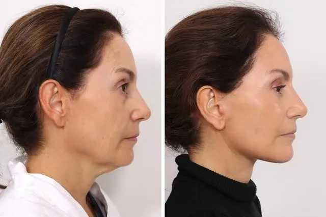 Before and after deep plane facelift — -1-year-old patient, frontal view by Dr. David Rosenberg