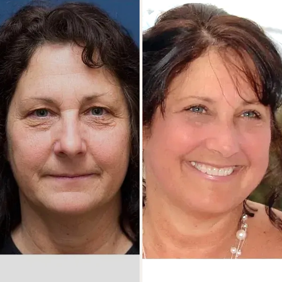 Avant & Après - Deep Plane Facelift par Dr. Leland Deane