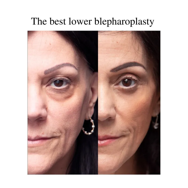 Avant & Après - Deep Plane Facelift par Dr. Leland Deane