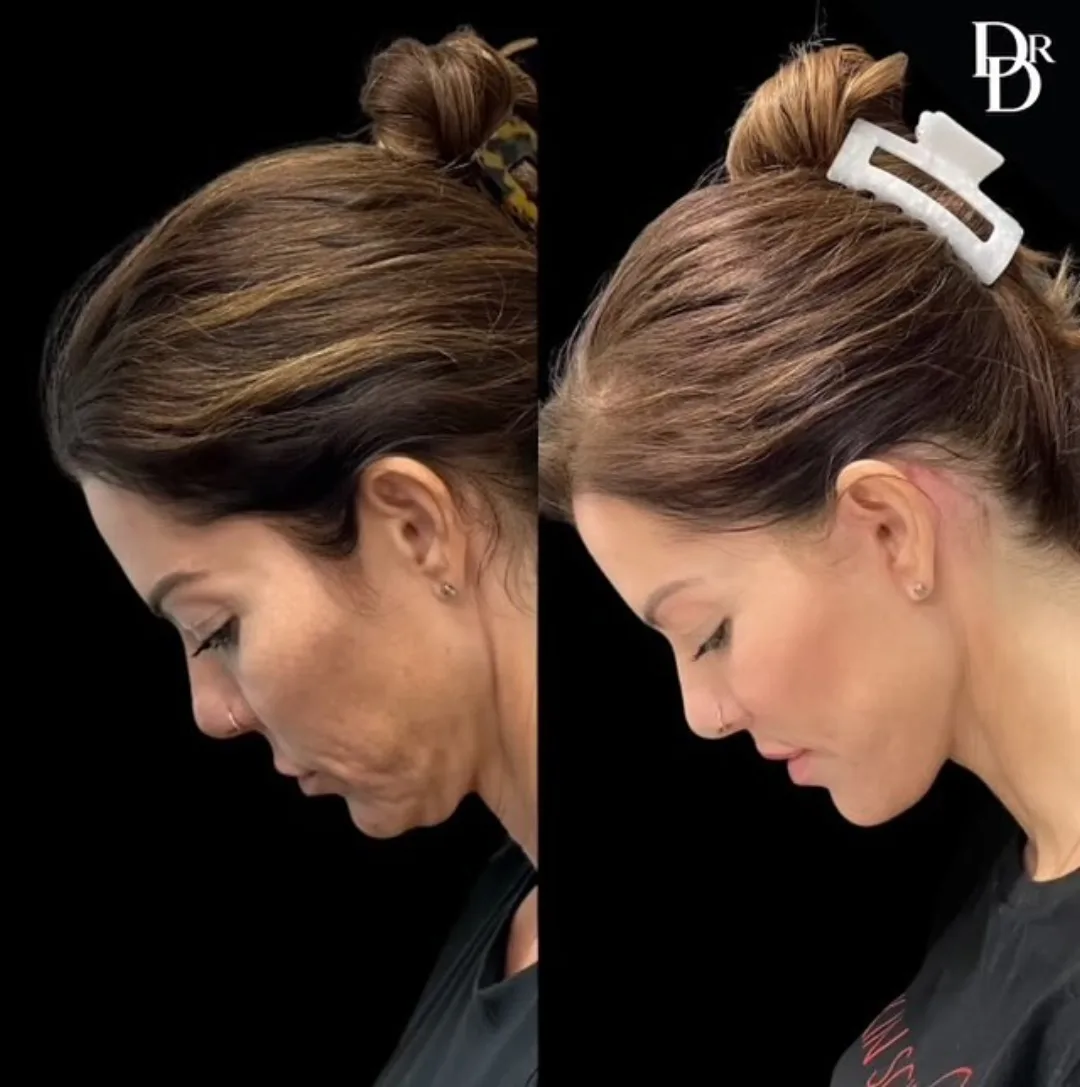 Before and after deep plane facelift — 45-year-old woman, left profile view, 6mo post-op by Dr. Demetri Arnaoutakis