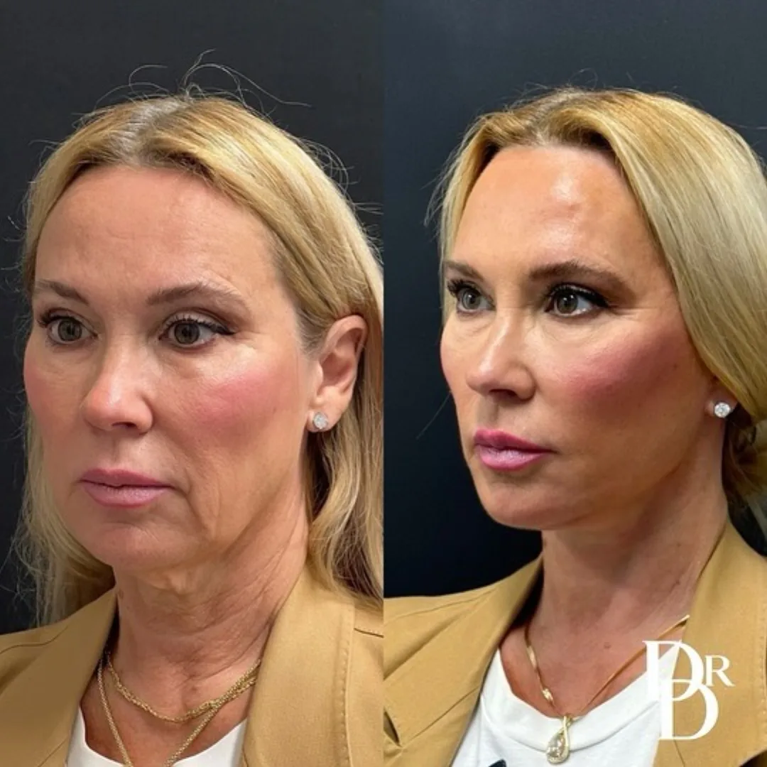 Before and after deep plane facelift — 52-year-old woman, three-quarter view, 6mo post-op by Dr. Demetri Arnaoutakis