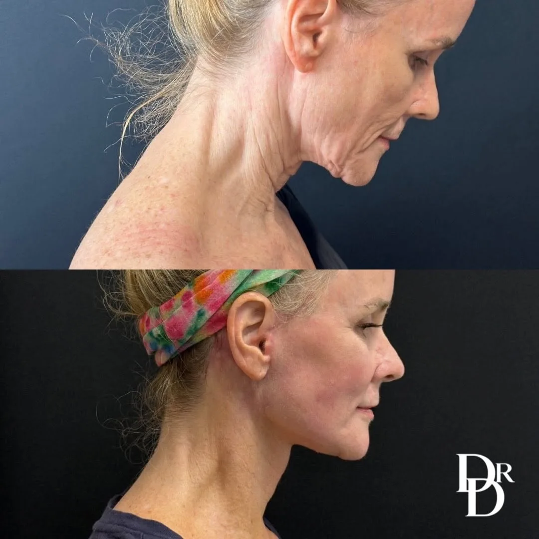 Before and after deep plane facelift — 62-year-old woman, right profile view, 1mo post-op by Dr. Demetri Arnaoutakis
