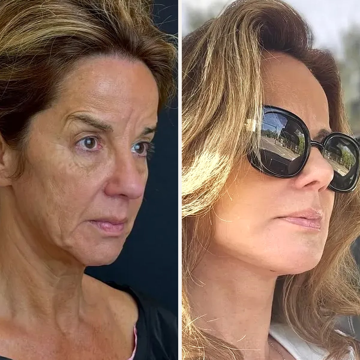Before and after, Deep Plane Facelift