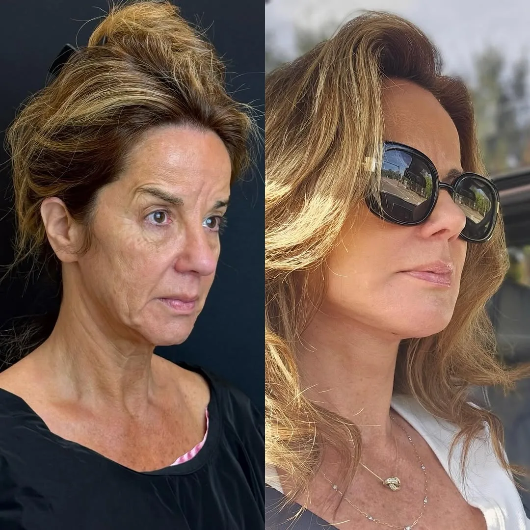 Before and after deep plane facelift — 52-year-old woman, three-quarter view, 9mo post-op by Dr. Demetri Arnaoutakis