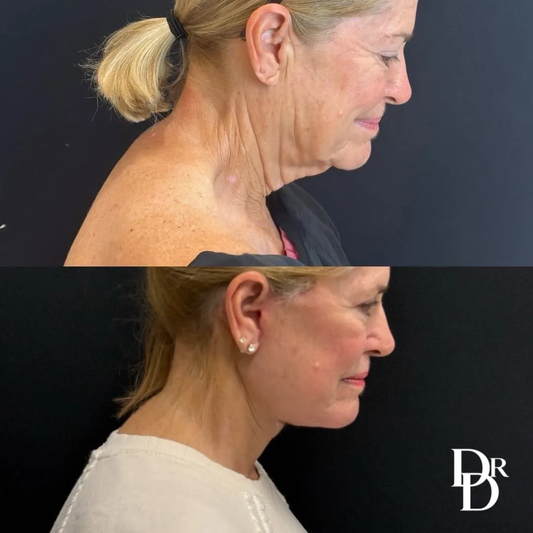 Before and after deep plane facelift — 65-year-old woman, left profile view, 6mo post-op by Dr. Demetri Arnaoutakis