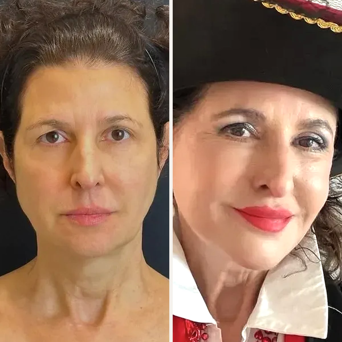 Before and after, Deep Plane Facelift