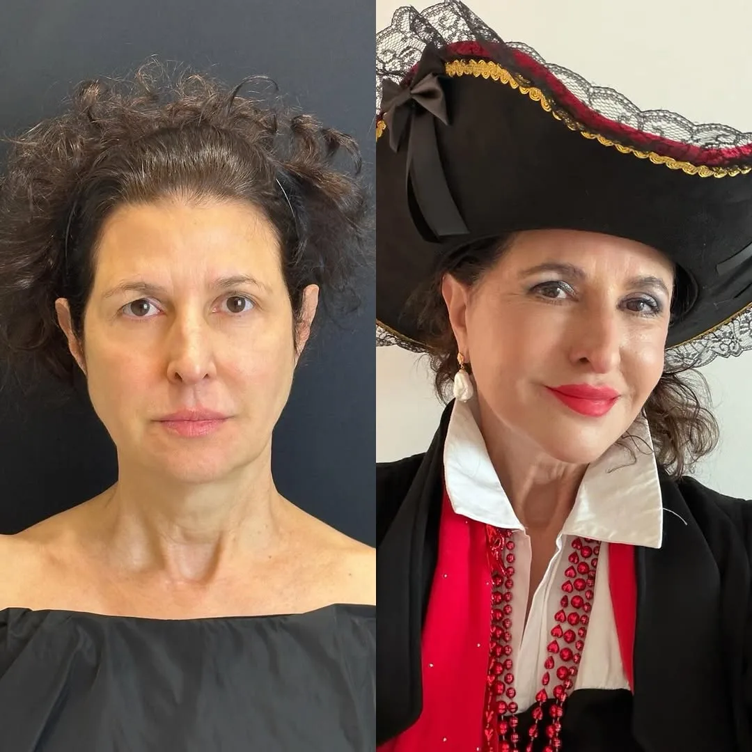 Before and after deep plane facelift — 52-year-old woman, three-quarter view, 24mo post-op by Dr. Demetri Arnaoutakis