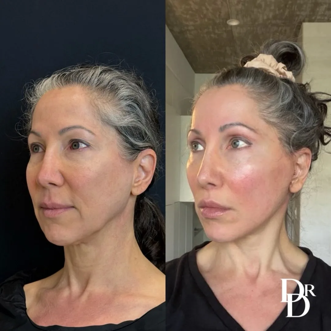 Before and after deep plane facelift — 48-year-old woman, oblique left view, 6mo post-op by Dr. Demetri Arnaoutakis