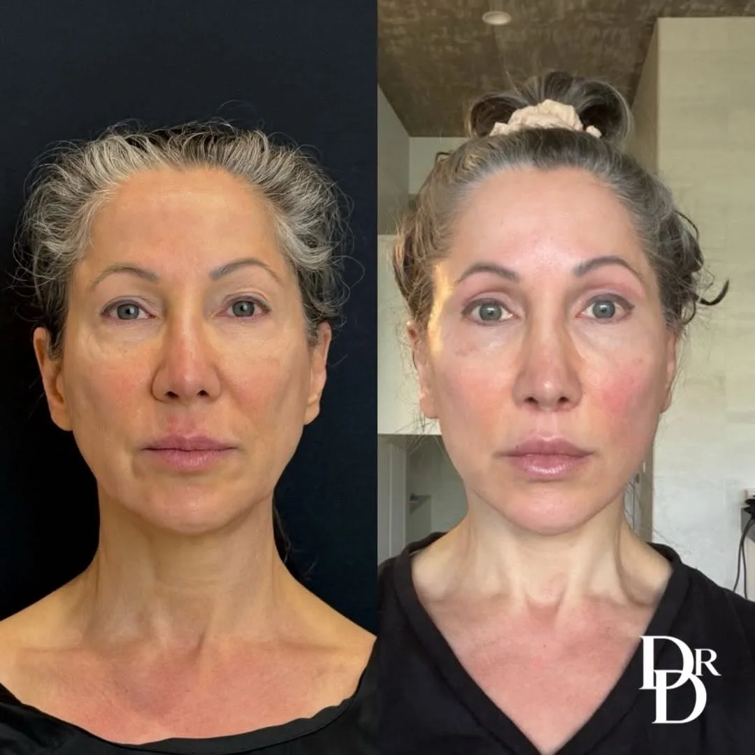 Before and after deep plane facelift — 52-year-old woman, frontal view, 6mo post-op by Dr. Demetri Arnaoutakis