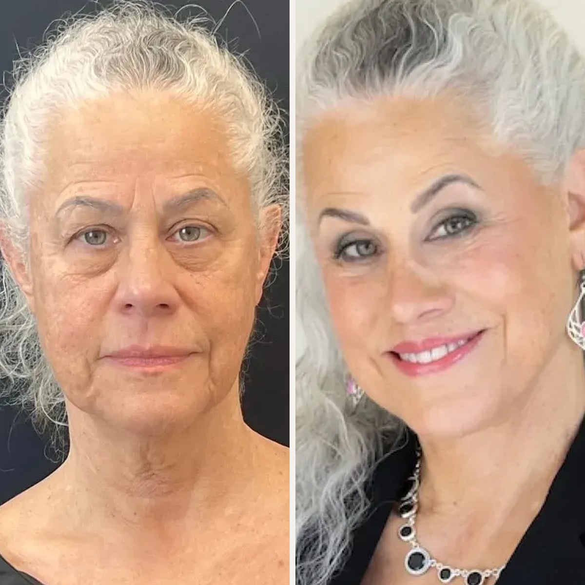 Before and after, Deep Plane Facelift