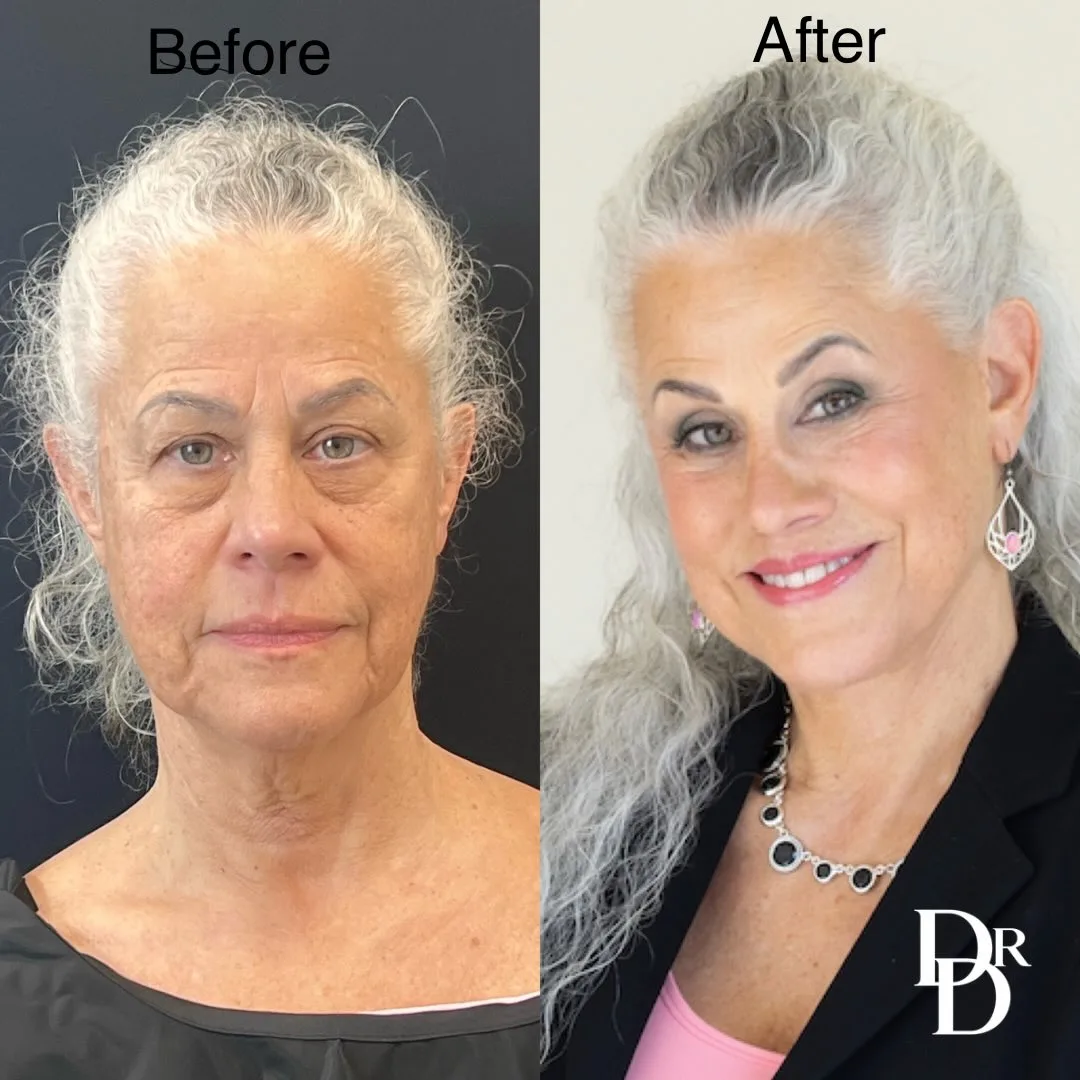 Before and after deep plane facelift — 65-year-old woman, oblique right view, 9mo post-op by Dr. Demetri Arnaoutakis