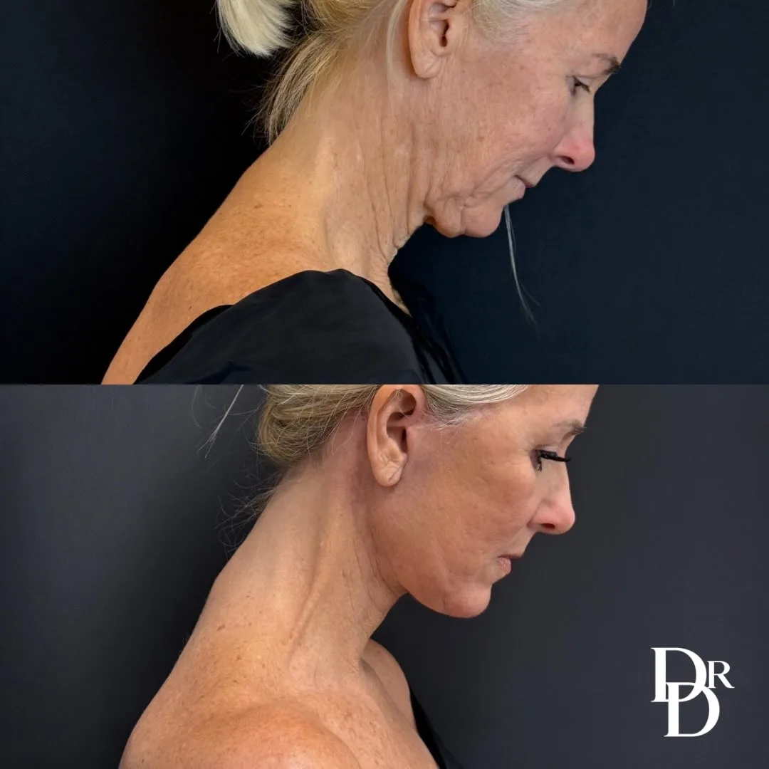 Before and after deep plane facelift — 64-year-old woman, right profile view, 1mo post-op by Dr. Demetri Arnaoutakis