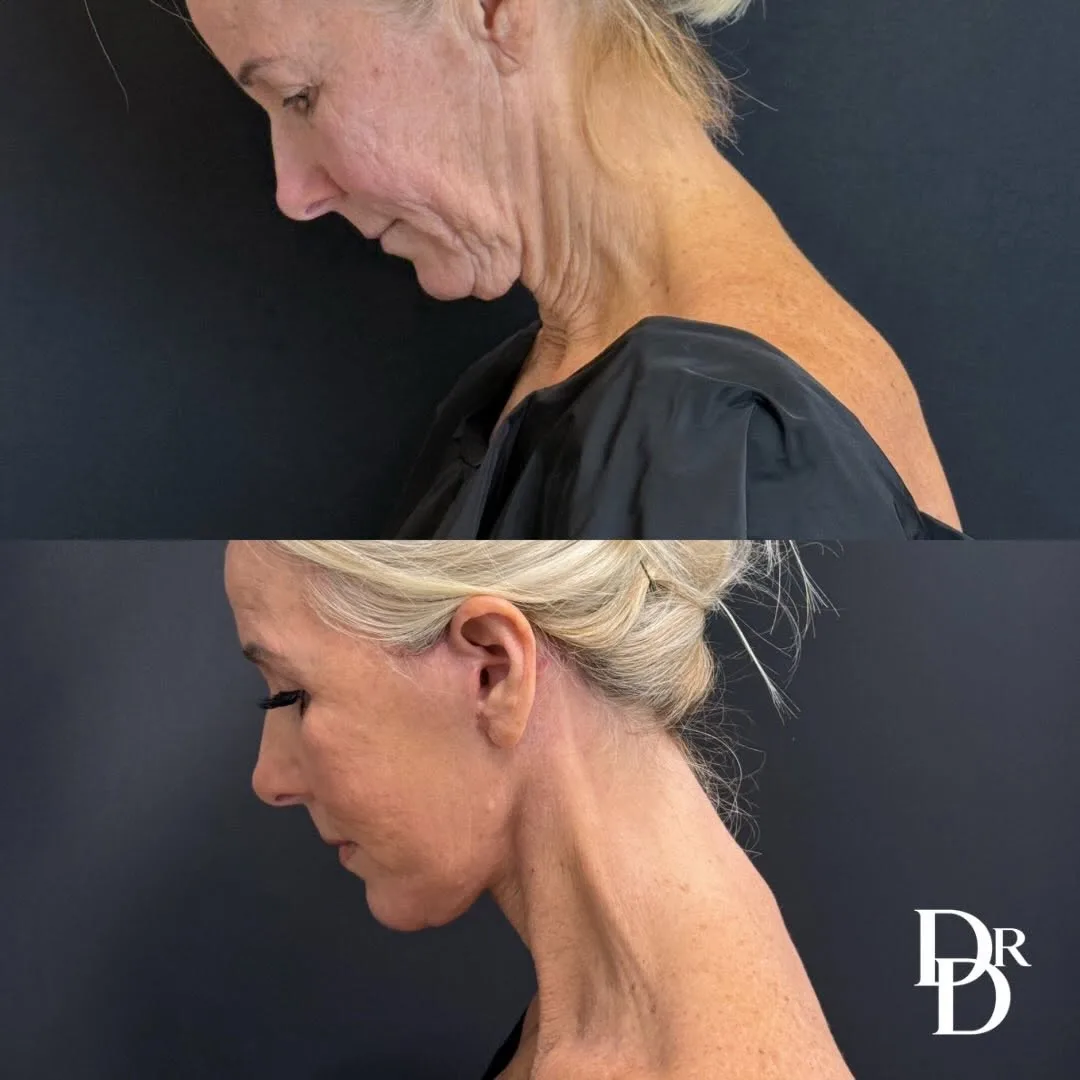 Before and after deep plane facelift — 64-year-old woman, left profile view, 1mo post-op by Dr. Demetri Arnaoutakis