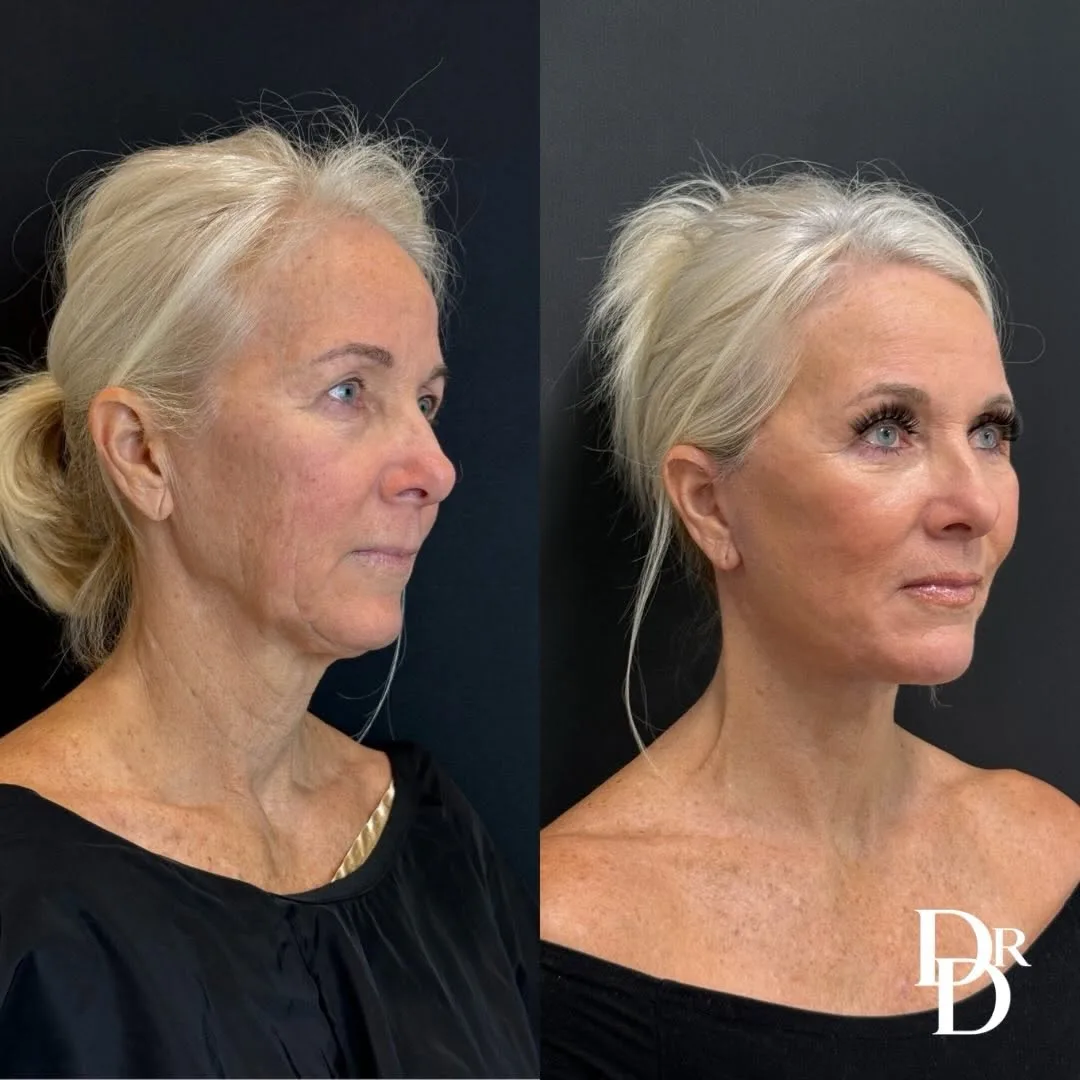 Before and after deep plane facelift — 64-year-old woman, three-quarter view, 1mo post-op by Dr. Demetri Arnaoutakis
