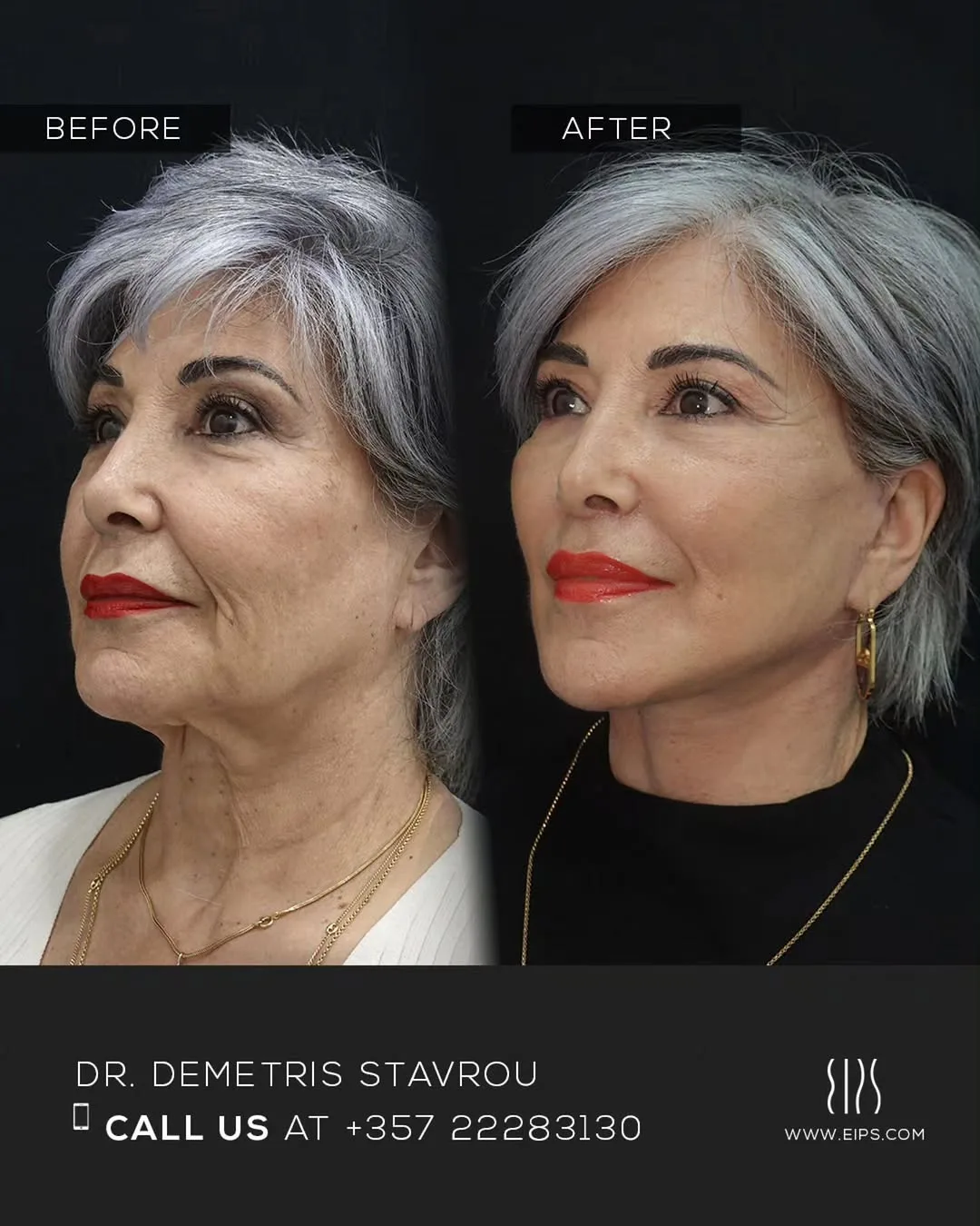 Before and after — Dr. Demetris Stavrou