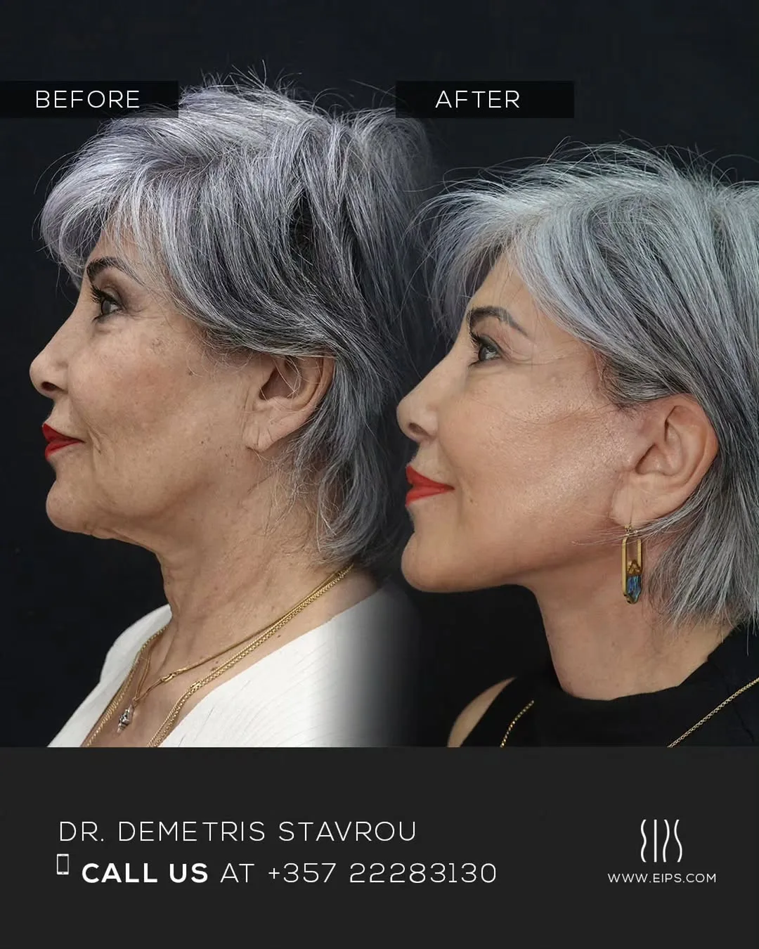 Before and after — Dr. Demetris Stavrou