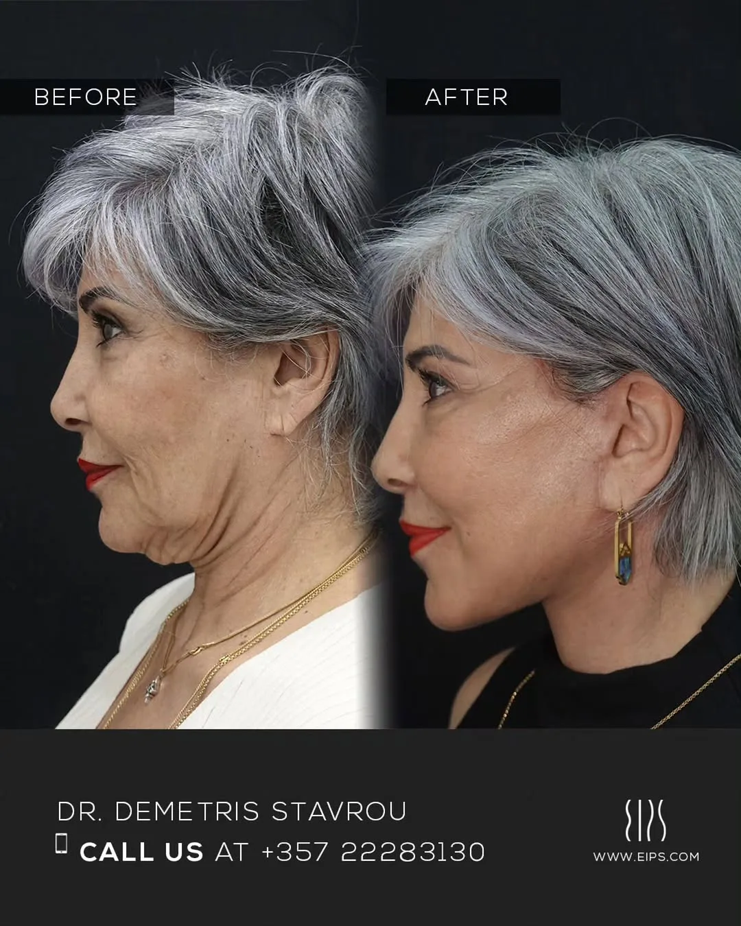 Before and after — Dr. Demetris Stavrou