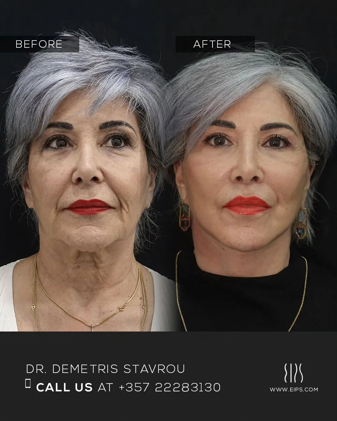 Before and after — Dr. Demetris Stavrou
