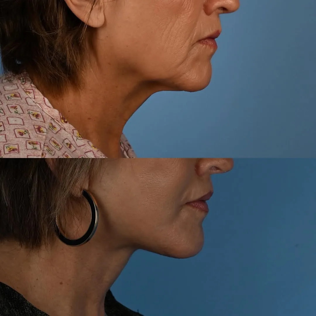 Before and after deep plane facelift — 58-year-old woman, three-quarter view, 1mo post-op by Dr. Derek Ford