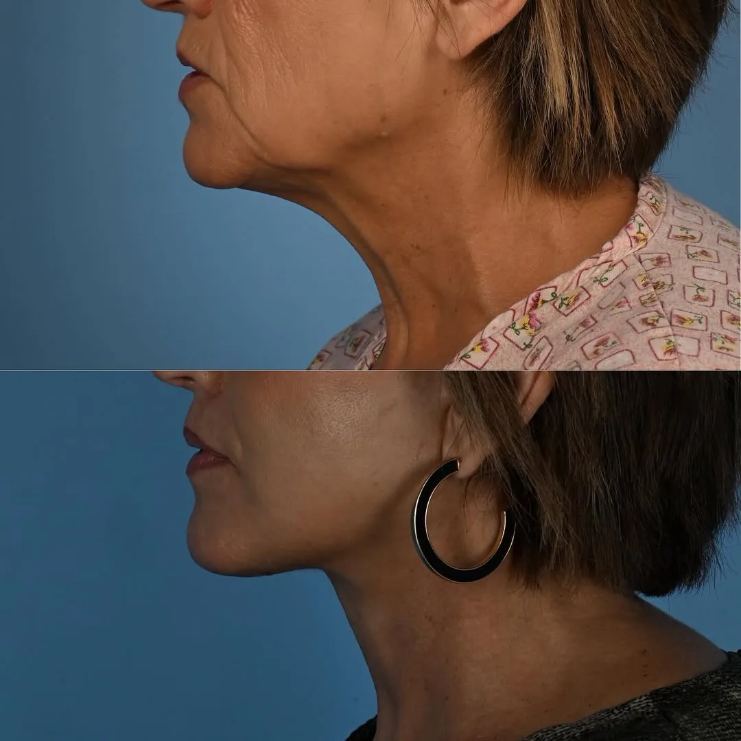 Before and after deep plane facelift — 58-year-old woman, three-quarter view, 1mo post-op by Dr. Derek Ford