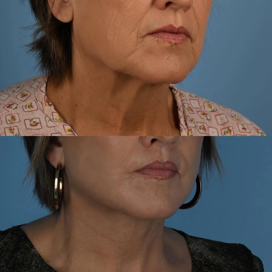 Before and after deep plane facelift — 58-year-old woman, oblique right view, 1mo post-op by Dr. Derek Ford