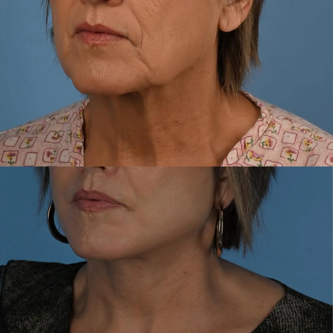 Before and after deep plane facelift — 58-year-old woman, oblique left view, 1mo post-op by Dr. Derek Ford