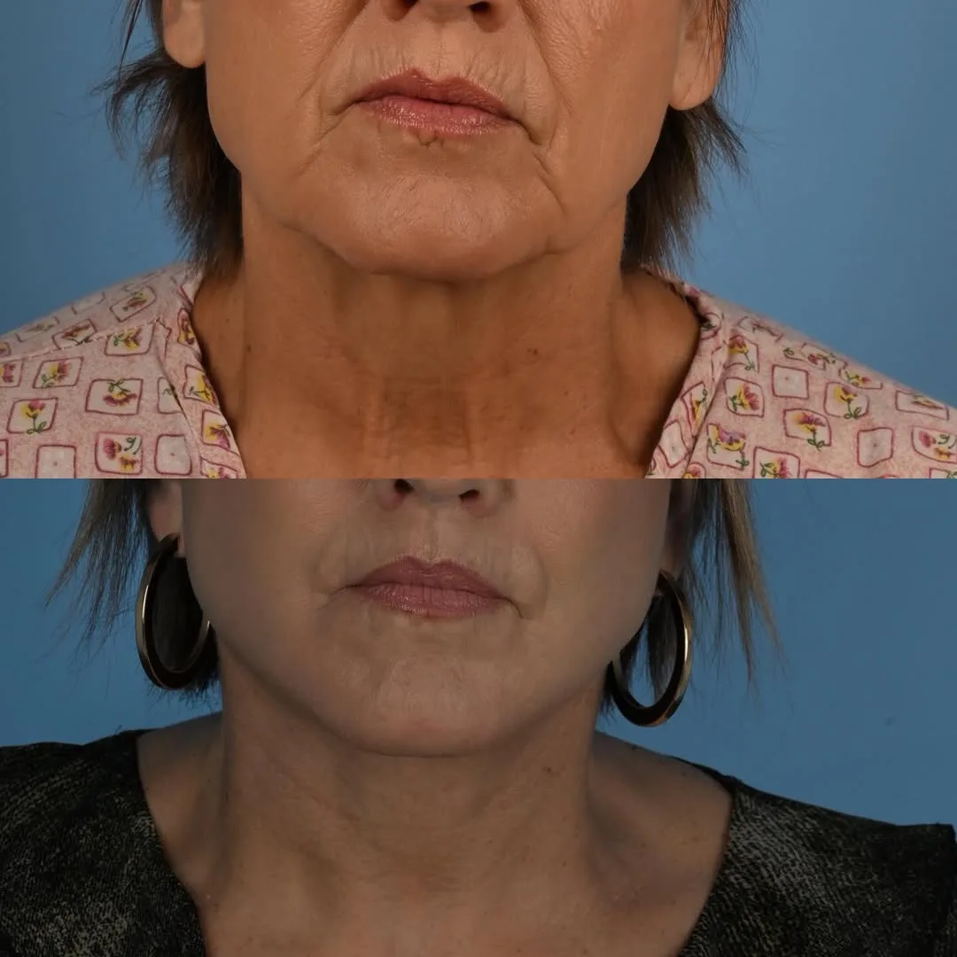 Before and after deep plane facelift — 58-year-old woman, frontal view, 1mo post-op by Dr. Derek Ford