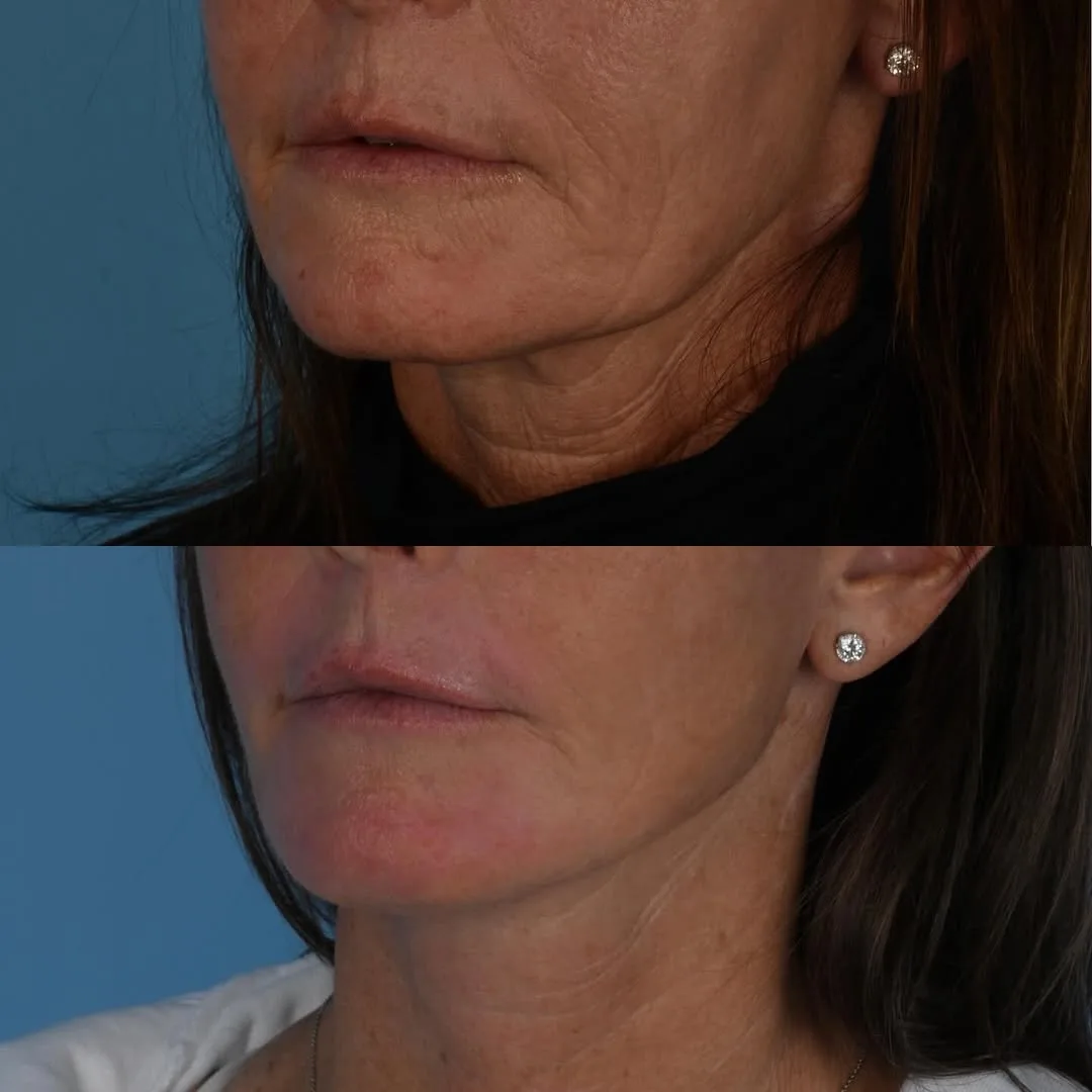 Before and after deep plane facelift — 55-year-old woman, oblique left view, 6mo post-op by Dr. Derek Ford