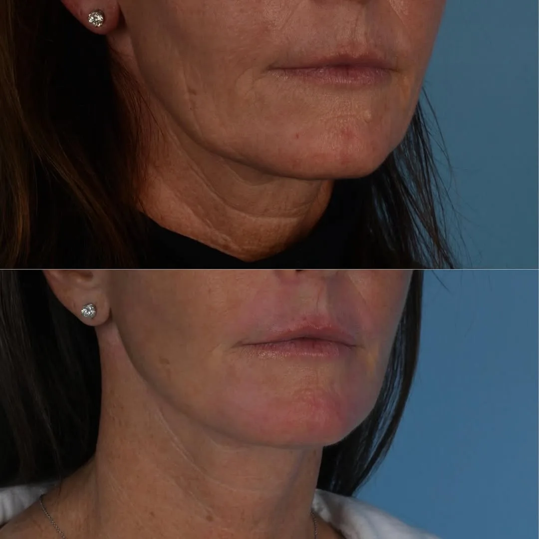Before and after deep plane facelift — 52-year-old woman, oblique right view, 6mo post-op by Dr. Derek Ford