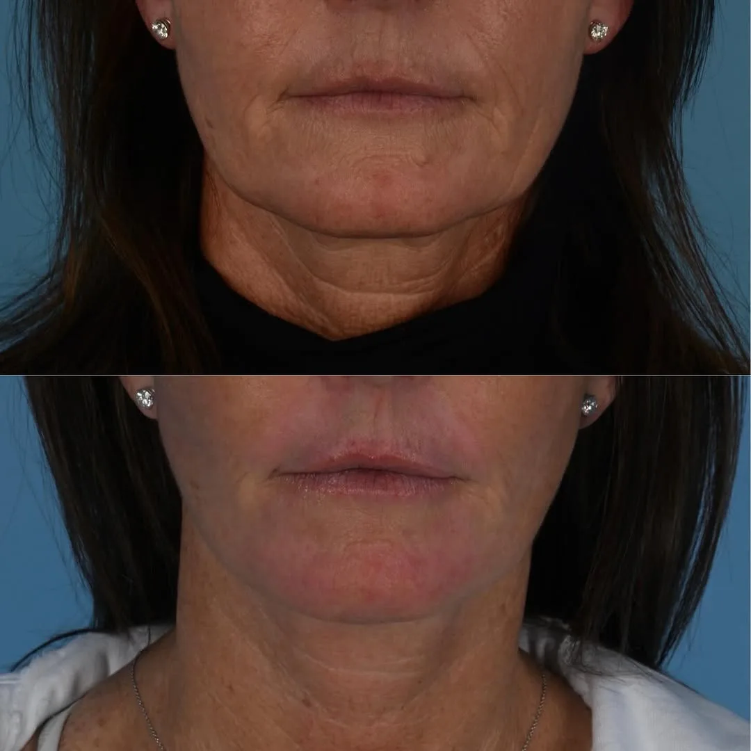 Before and after deep plane facelift — 55-year-old woman, frontal view, 7mo post-op by Dr. Derek Ford