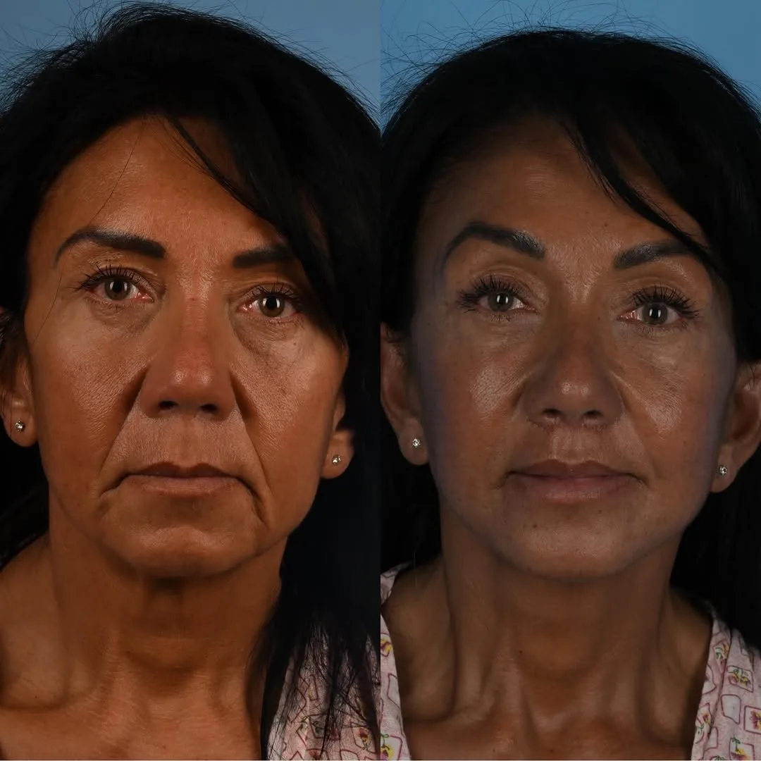 Before and after deep plane facelift — 55-year-old woman, frontal view, 7mo post-op by Dr. Derek Ford