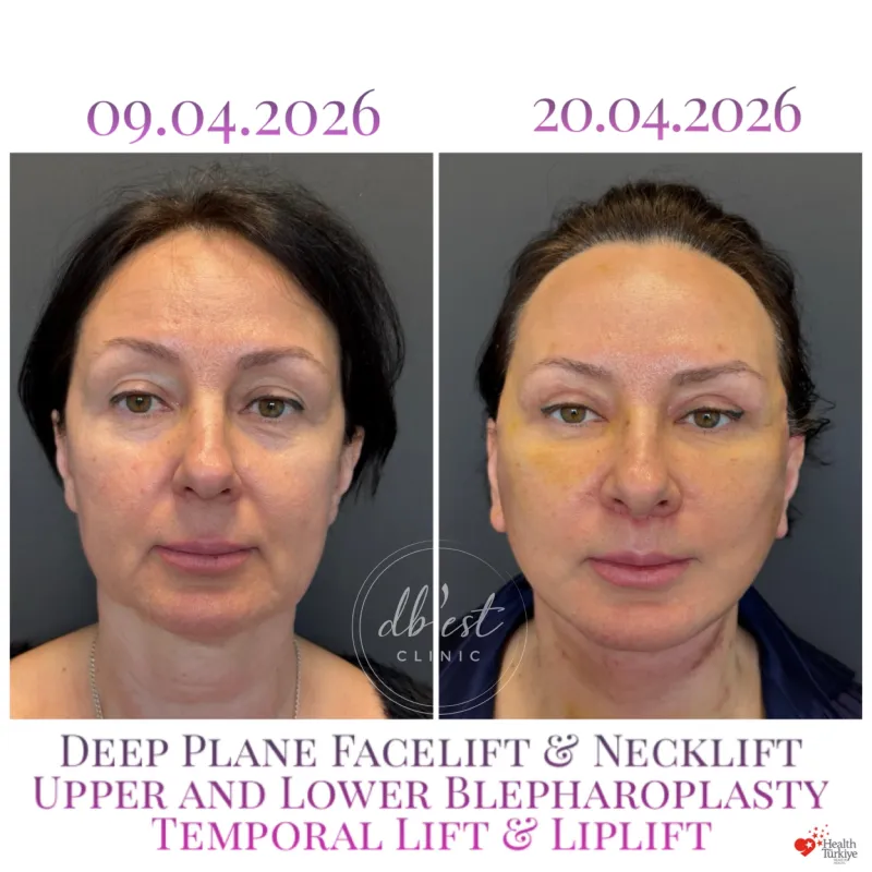 Before and after: Dr. Derya Bingöl