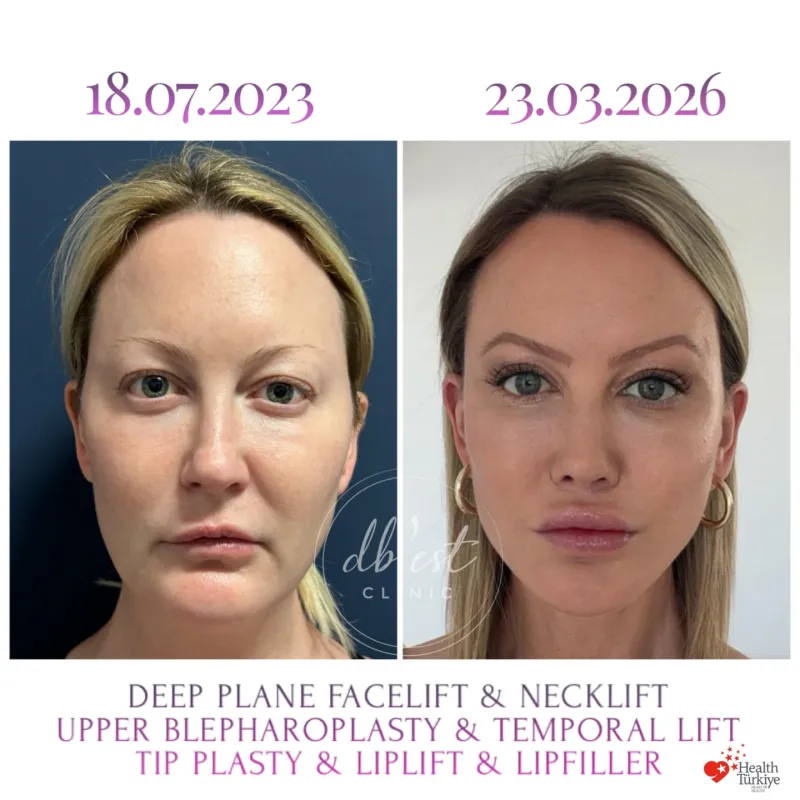 Before and after: Dr. Derya Bingöl