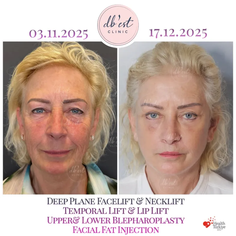 Before and after: Dr. Derya Bingöl