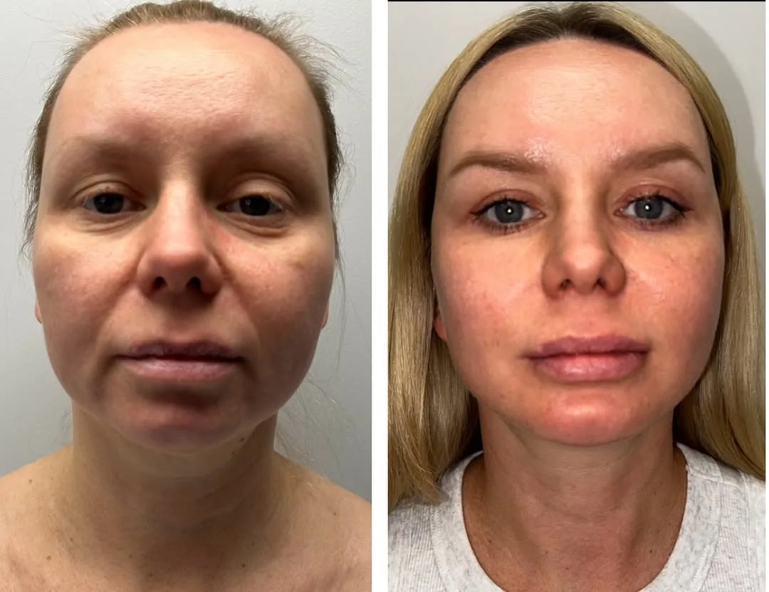 Before and after deep plane facelift — 45-year-old woman, frontal view, 7mo post-op by Dr. Dhaval Patel