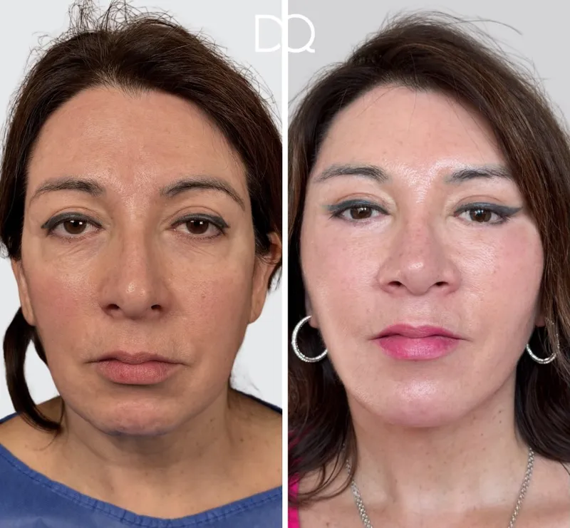 Before and after — Dr. Diego Quispe