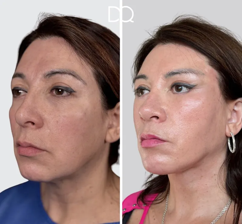 Before and after — Dr. Diego Quispe