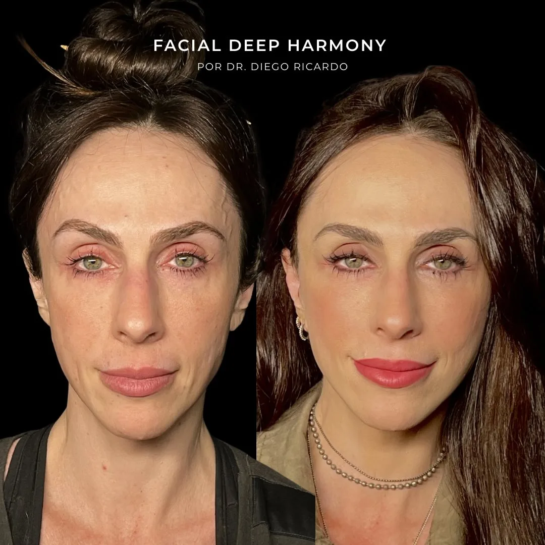 Before and after deep plane facelift — 42-year-old woman, frontal view, 6mo post-op by Dr. Diego Ricardo