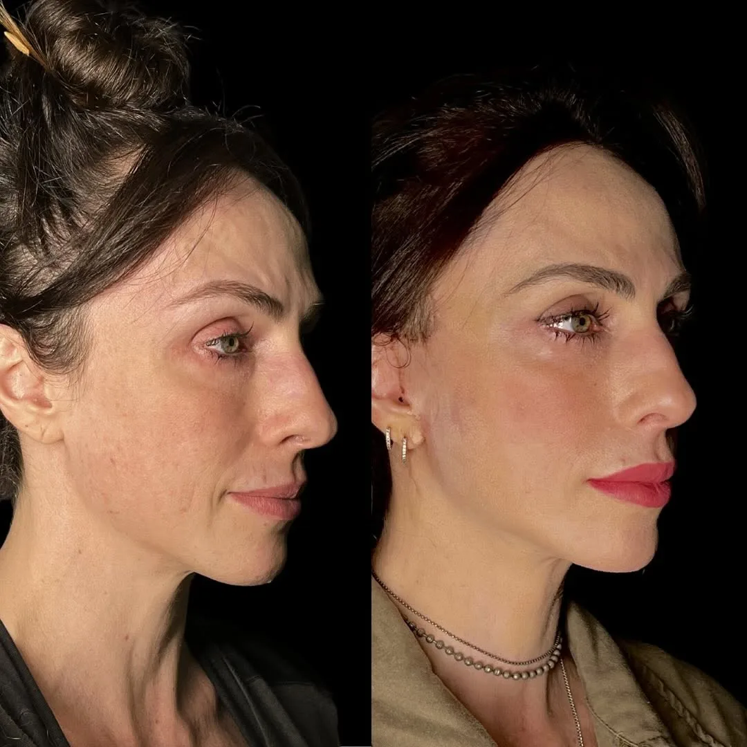 Before and after deep plane facelift — 48-year-old woman, right profile view, 6mo post-op by Dr. Diego Ricardo