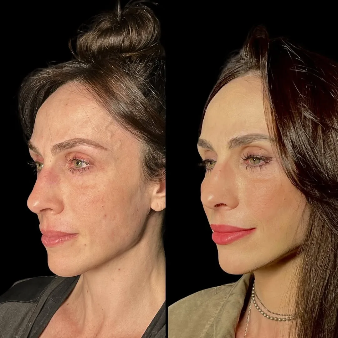 Before and after deep plane facelift — 45-year-old woman, right profile view, 6mo post-op by Dr. Diego Ricardo