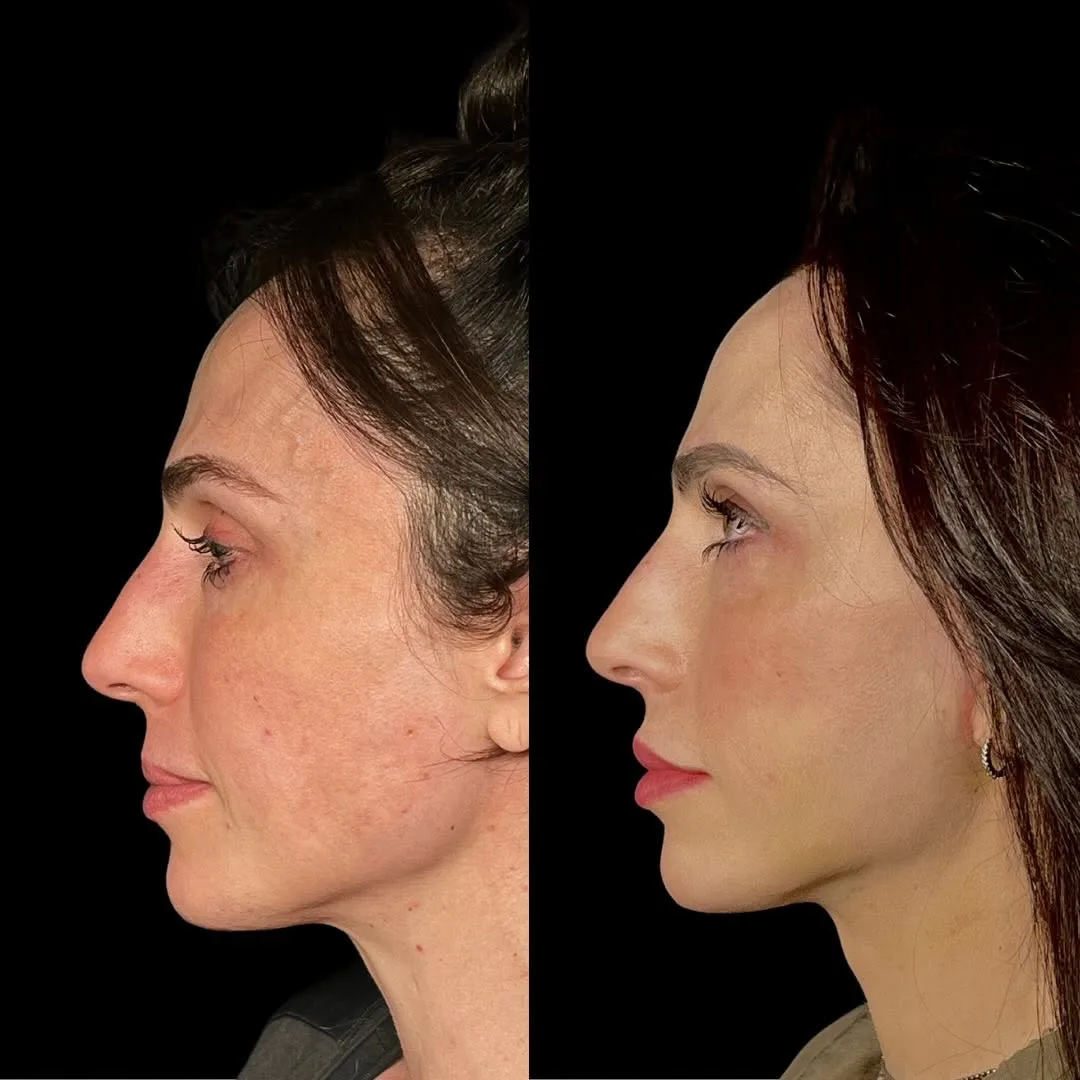 Before and after deep plane facelift — 42-year-old woman, right profile view, 6mo post-op by Dr. Diego Ricardo